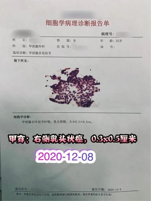  尽早|位置不好的甲状腺癌，即使癌灶特别小，也应该尽早手术！