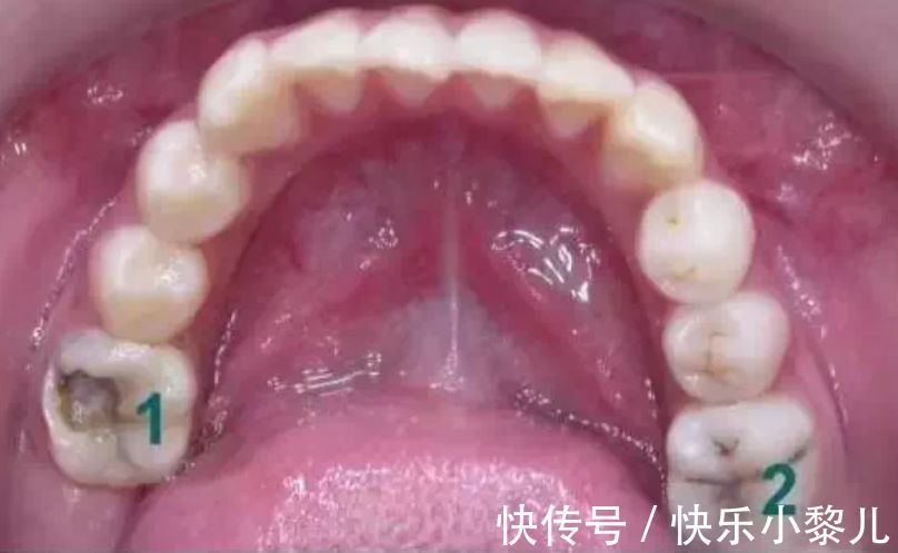 恒牙|6-12岁孩子换牙全过程:孩子能不能有一口好牙,这几点不能大意了