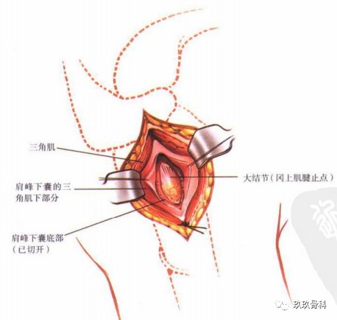 肩关节外侧入路|图文详解 | 肩关节