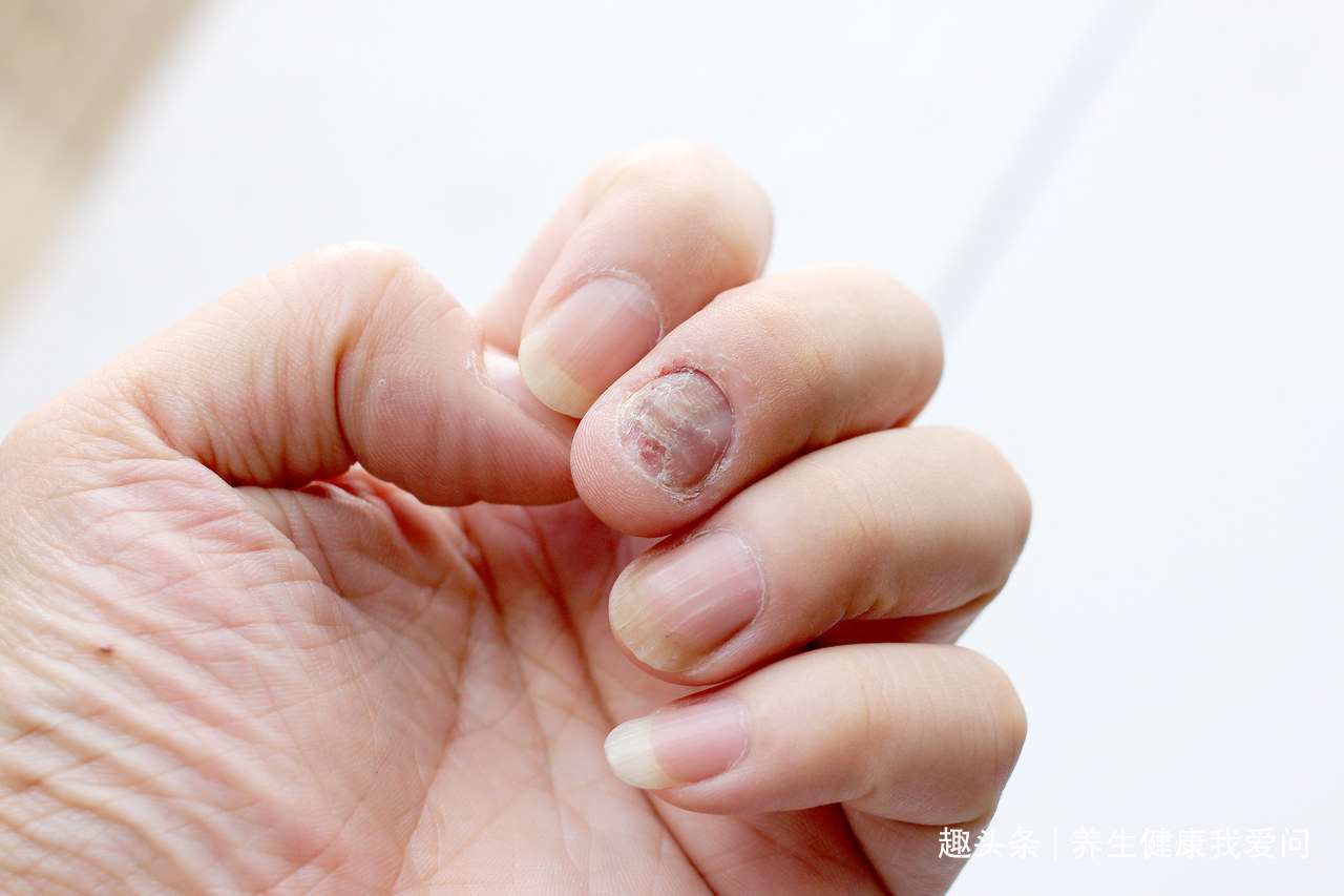 口腔溃疡|6种症状别“硬抗”,超过一定时间不愈可能是癌,建议及时就医