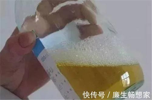 尿液|肝有问题,“下半身”会有3个症状,若是还没有,说明肝还不错