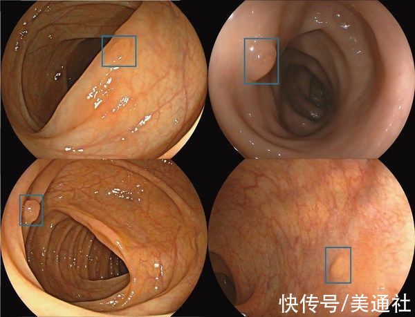 endoscreener|Wision A.I.：全球首个医疗AI领域独立外部随机对照试验发表