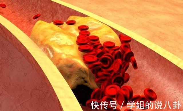 心血管医生|橙子是高血脂的“催化剂”吗?心血管医生:这三种水果,别贪吃