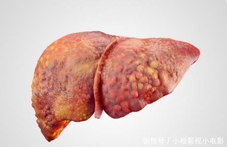 绿豆|60岁大叔肝硬化，坚持吃半年绿豆养肝，现在他的肝怎么样了？