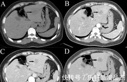 肝癌|40岁男子一天一鸭蛋,确诊肝癌,医生或比酒还上伤肝,趁早忌口