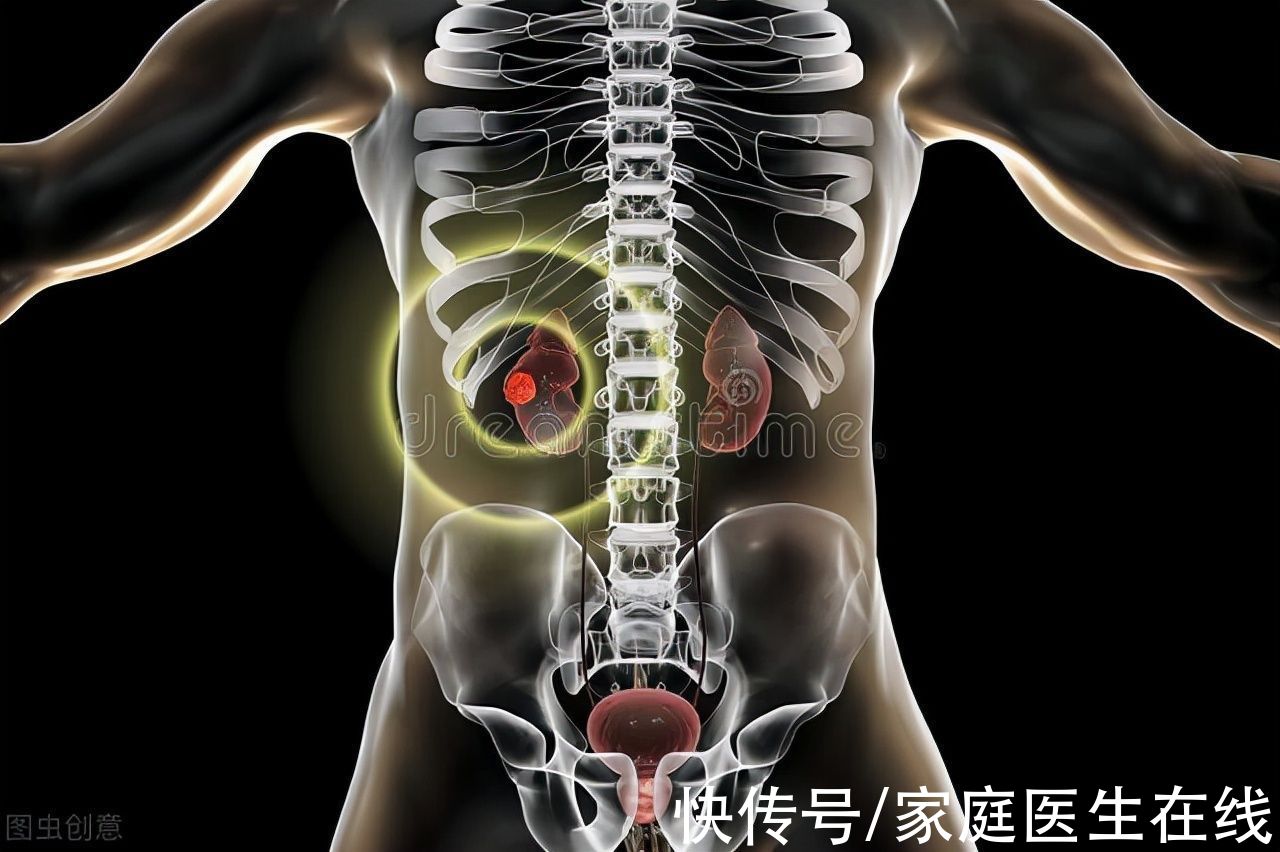 治疗|肾癌的发病率越来越高？了解这6个小常识，早点预防肾癌