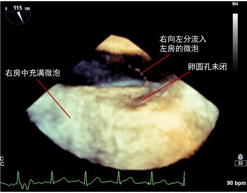 晶晶|女童头痛竟是心脏问题，无痛经食管超声心动图精准锁定“元凶”