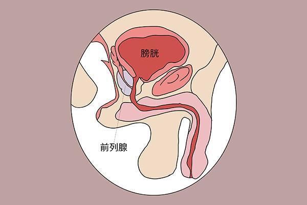 前列腺疾病|前列腺肥大，发展成前列腺癌的几率有多大？医生告诉你实话