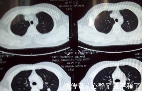 体检|为什么体检结果一切正常,4天后查出癌症晚期?