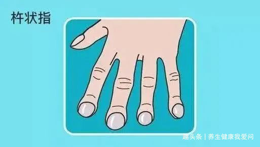 高血脂|寿命短的女人，手上会发出3种信号，若一个不占，说明你还算健康