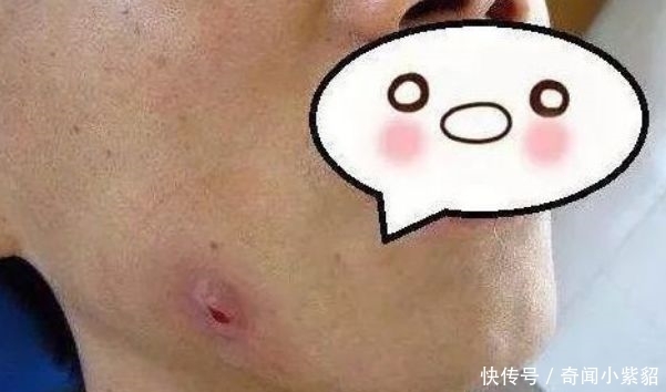 小伙|小伙经常熬夜,脸颊突发的就肿了起来,到了医院检查完让人不淡定