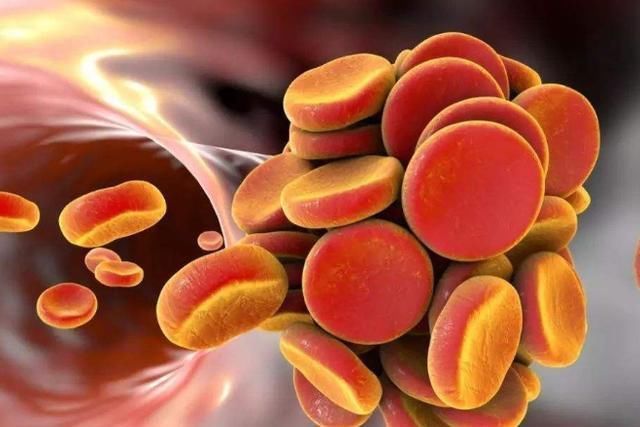 血液稠,血管硬,养成3个习惯,学会2个动作,冲净血栓,通血管