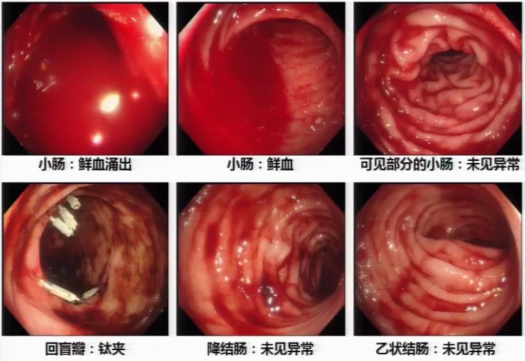 休克|反复便血十余天，一度出现失血性休克，原因竟然是……