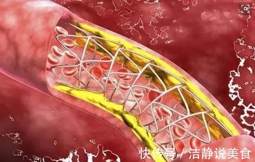 血脂|血脂高不高,看小腿就懂若有这4种症状,或在暗示血脂偏高了