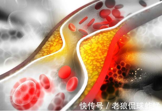 睡眠时间|检查出血脂高,不要慌!4个方法帮你“控制”高血脂,远离并发症