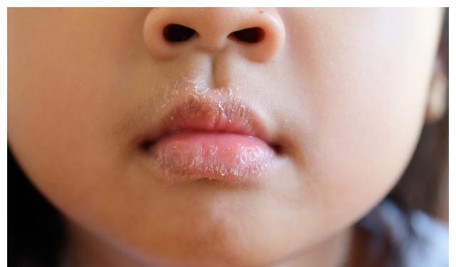 润唇膏|冬季孩子嘴唇起皮、干裂还出血?三招教你正确护理,光喝水没用