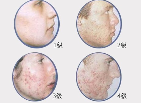 脓疱|痤疮按严重程度分4级,你是哪一级?另附一份有效治疗方法建议收藏!