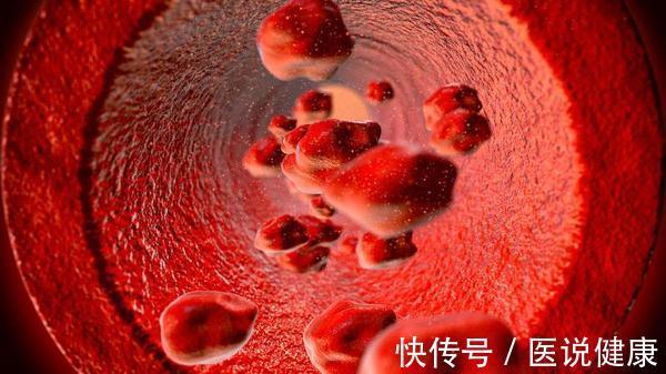 血栓|身体莫名出现这4种异常,或许是血栓正在靠近,需重视