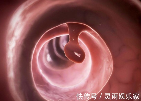 肠息肉|3种肠息肉一定要及时切除，没事常吃3种食物，可更好预防肠癌