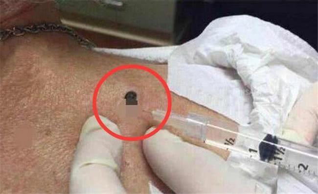 儿子|宝宝后背长颗“黑痣”,一碰就痛,医生取出的东西妈妈无法淡定