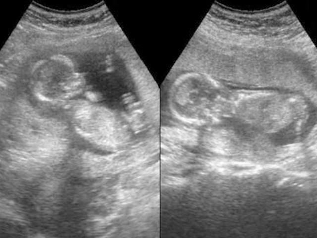 怀孕|25岁妈妈怀孕7个月引产,看到胎儿的那一刻,她彻底沉默了