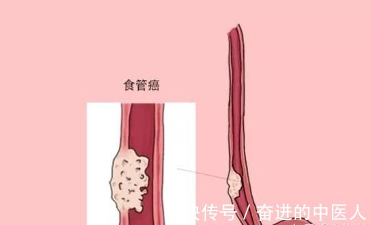 食道瘤|成都中医肿瘤医院,成都中医肿瘤研究院:食道瘤难治?看中医专利组方如何治疗!