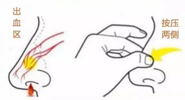 黏膜|流鼻血高发季到了，伴有5类症状请立即就医