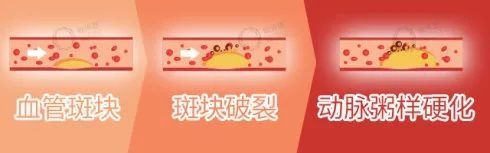 关注隐形的健康“杀手”——血脂异常|科普 | 冠心病