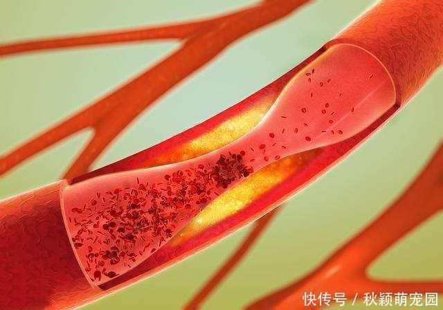 清理血管|怎样才能把血管壁上的垃圾或斑块清除掉？医生告诉您答案！