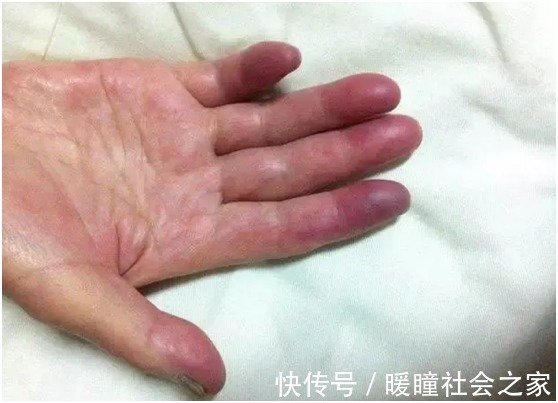 脑梗|血脂高不高，看手指就知道，若出现这2个表现，脑梗可能离你不远