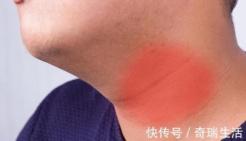 激素|有结节的人,甲状腺想让你“拉黑”的食物,再喜欢也少往嘴里送