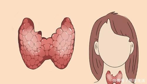迹象|肿瘤医生：身体频繁有3个迹象，或是甲状腺癌“一级预警”