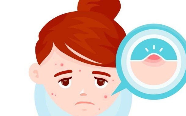 复合彩光|痤疮一直不好怎么办？这3条治疗痤疮的方法建议收好