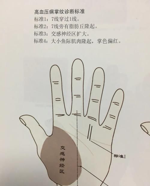  发现|有没有冠心病？一手一脸就能辨！中医教你发现端倪，3招去除病根