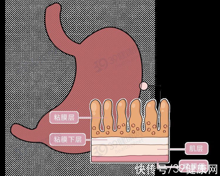 消化液|再三提醒：胃部溃疡时，身体会发出3个“求救信号”，别太晚知道