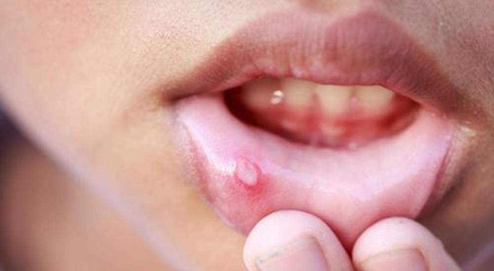 痊愈|得了口腔溃疡就是上火了医生教给3个办法,快速痊愈,吃嘛嘛香