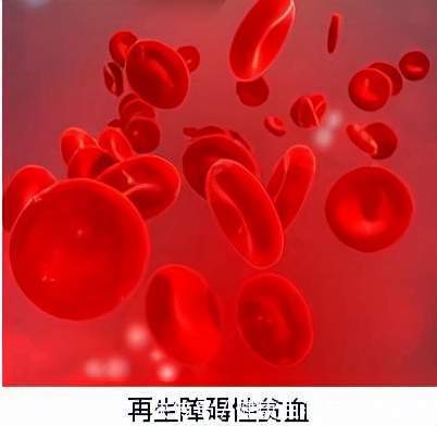 乏力|频繁头晕、乏力可能是贫血!谢别录:贫血有很多种,看你是哪一种