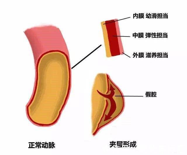 主动脉|54岁“麻将迷”强忍胸痛，就为看了胡一把，结果真“胡”了！