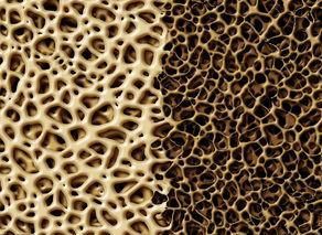 骨密度|骨密度低的人，医生给出建议：常补3种维生素，或助骨量增加