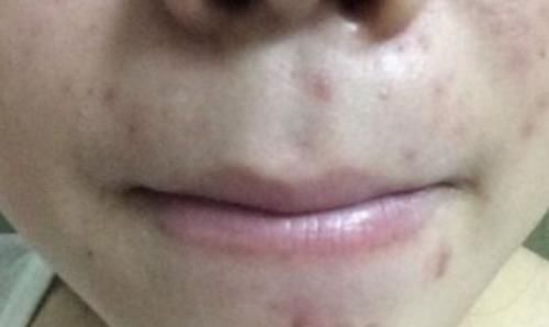 肝脏|29岁小伙，腹泻就医，查出肝硬化，医生警告：这道“早餐”不要碰