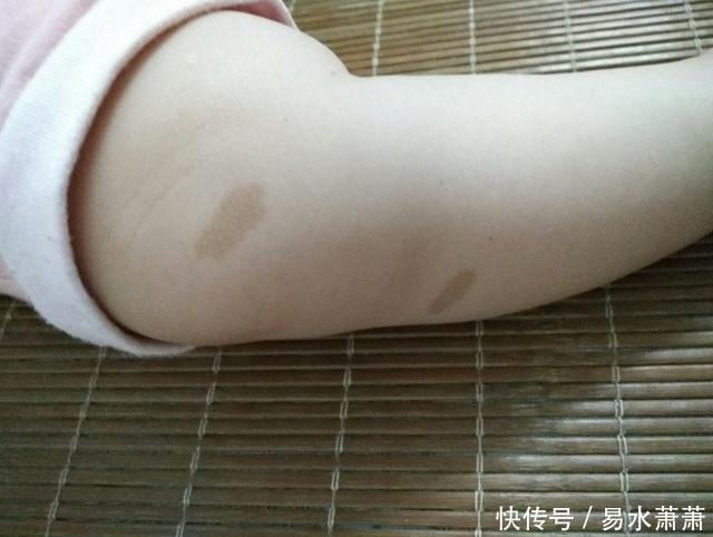 李女士|为什么有的宝宝会有“胎记”产科医生孕期要避免这3种行为