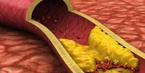 血脂升高应该怎么办?医生:常吃6种食物,血脂或许轻松降下去