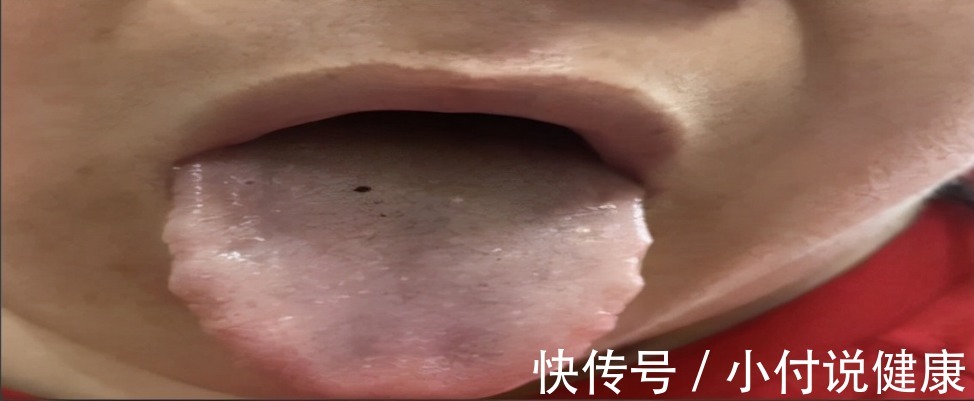 体质|两个位置测血瘀，一个中成药化淤血，4种血瘀体质了解一下