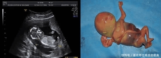 分娩|胎儿畸形高发期,安全度过孕初期,孕妈们就可以安心等待分娩了