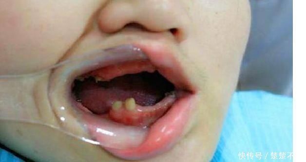 牙龈癌|6岁男童被查出牙龈癌晚期,牙齿掉光了,孩子爱喝家长要警惕