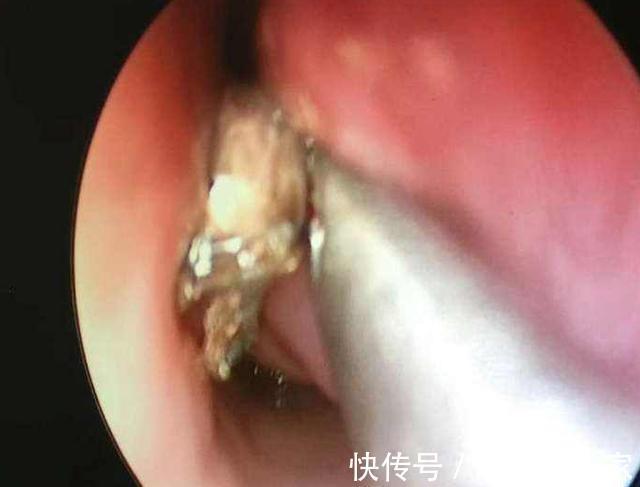 妈妈|6岁男孩不停打喷嚏,妈妈用手电筒一照,身上的汗毛都竖起来了