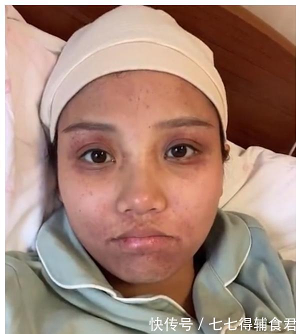 紫青|陕西一女子顺产后状态吓人,疼到满脸皮下出血,与生产前判若两人