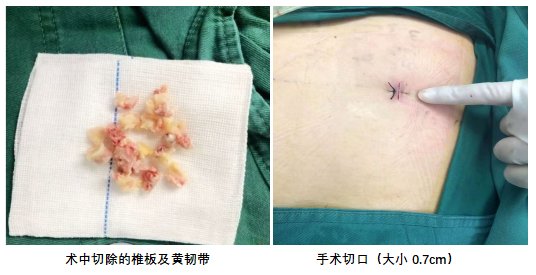 李奶奶|多年走路双腿像灌铅,济南市中心医院小切口解决腰椎管狭窄