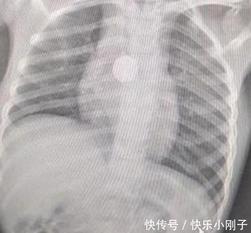 检查|5岁孩子突然暴瘦,医生检查时让“摘下项链”,宝妈得知原因泪崩