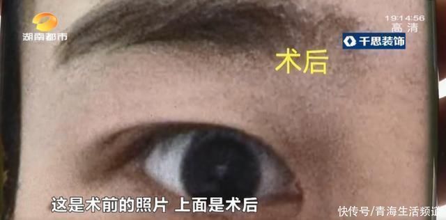 手术 女子花5800做双眼皮手术“变”单眼皮,欲退款遭拒,店家收据呢